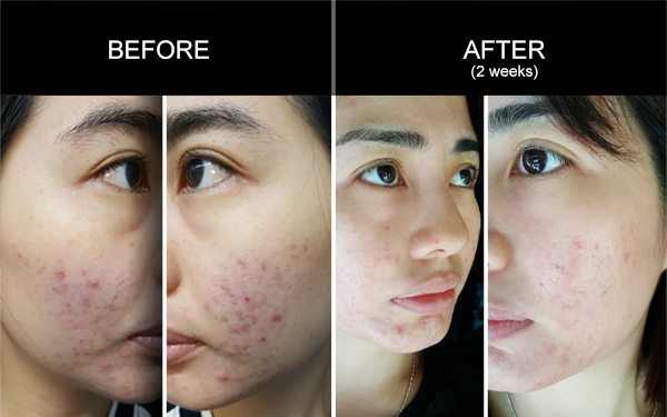 Testimonials for Anmyna Acne Care, Testimonials, Anmyna Online, Great Results, Skincare, RESULTS YOU’LL LOVE, our customers, happy customer, before after result