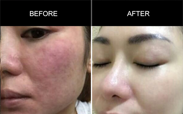 Anmyna Mask, Before and After, Testimonials, Anmyna Online, Great Results, Skincare, RESULTS YOU’LL LOVE, our customers, happy customer, before after result